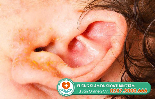 Hình ảnh về triệu chứng Bệnh lậu ở lỗ tai