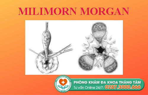 phương pháp Milimorn Morgan