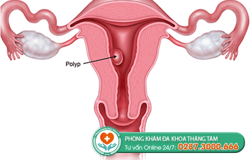 Hình ảnh về polyp cổ tử cung
