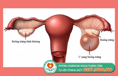 Hình ảnh về u nang buồng trứng