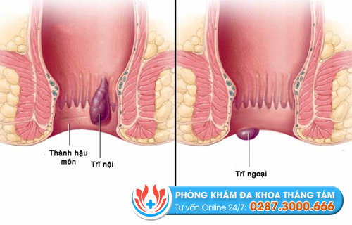 Hình ảnh minh họa bệnh trĩ