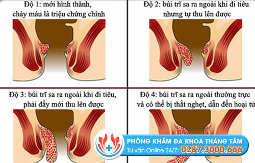 Tình trạng sa búi trĩ phát triển qua nhiều giai đoạn