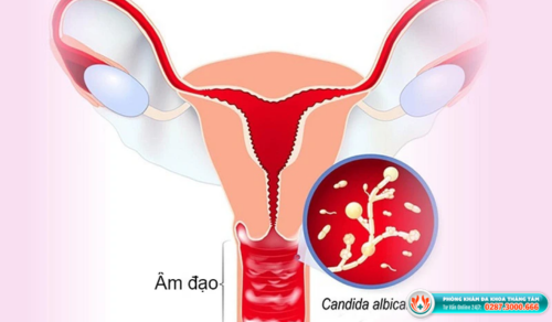 Nấm Candida ở nữ