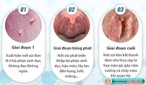 Sùi mào gà ở lưỡi