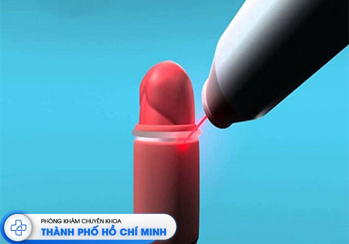 cat-bao-quy-dau-bang-laser-o-dau-uy-tin-tai-tphcm